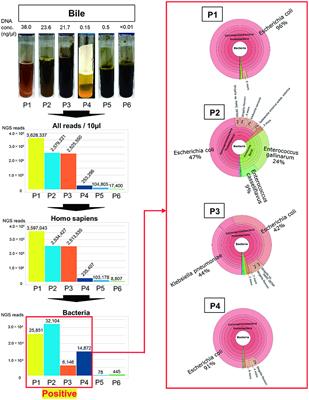 Comprehensive Diagnosis of Bacterial Infection Associated with <mark class="highlighted">Acute Cholecystitis</mark> Using Metagenomic Approach